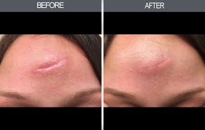 Scar Revision Before & After Gallery - Patient 4446675 - Image 1
