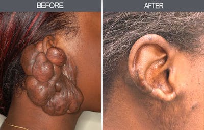 Scar Revision Before & After Gallery - Patient 4446676 - Image 1