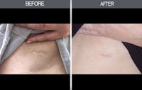 Scar Revision Before & After Gallery - Patient 4446677 - Image 1
