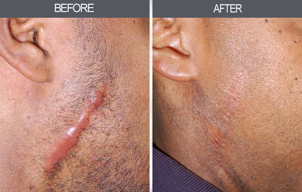 Patient 4446678 | Scar Revision Before & After Photos | Dr. Darrick Antell