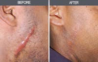 Scar Revision Before & After Gallery - Patient 4446678 - Image 1