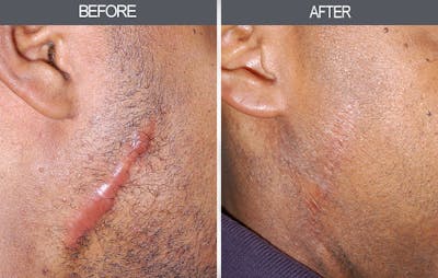 Scar Revision Before & After Gallery - Patient 4446678 - Image 1