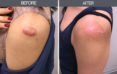 Scar Revision Before & After Gallery - Patient 4446679 - Image 1
