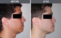 Rhinoplasty Before & After Gallery - Patient 4447203 - Image 1