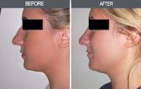 Rhinoplasty Before & After Gallery - Patient 4447204 - Image 1