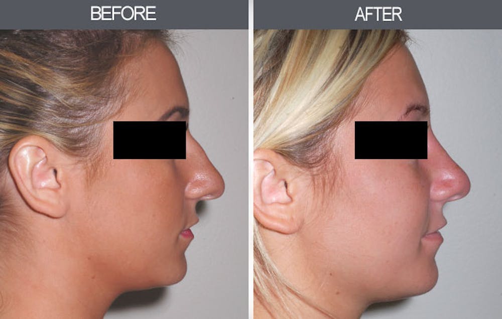 Rhinoplasty Gallery Before & After Gallery - Patient 4447204 - Image 2
