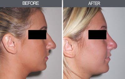 Rhinoplasty Before & After Gallery - Patient 4447204 - Image 2
