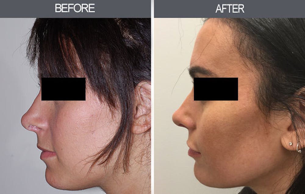 Rhinoplasty Gallery Before & After Gallery - Patient 4447205 - Image 1