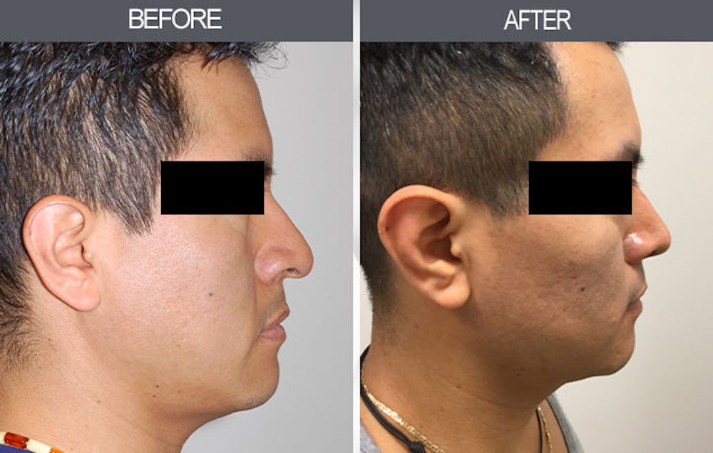 Rhinoplasty Before & After Gallery - Patient 4447206 - Image 1