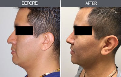 Rhinoplasty Gallery Before & After Gallery - Patient 4447206 - Image 2