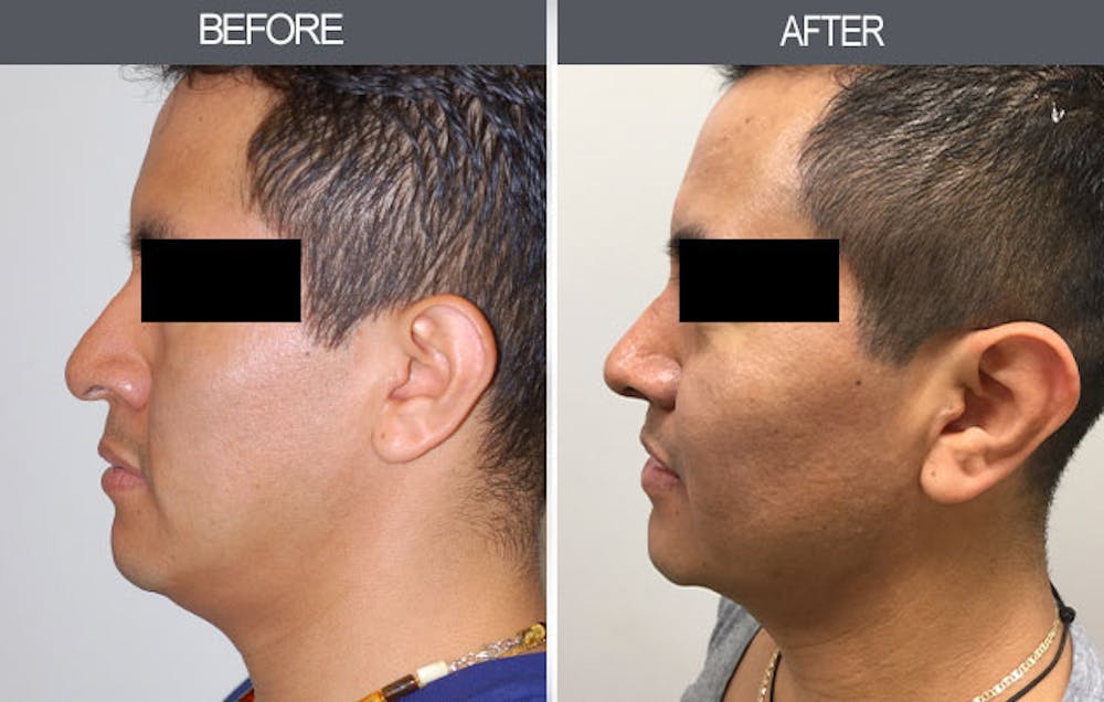 Rhinoplasty Before & After Gallery - Patient 4447206 - Image 2