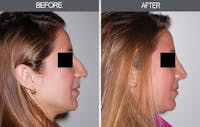 Rhinoplasty Gallery Before & After Gallery - Patient 4447207 - Image 1