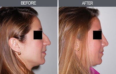 Rhinoplasty Gallery Before & After Gallery - Patient 4447207 - Image 1