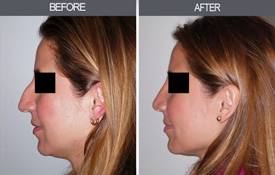 Rhinoplasty Gallery Before & After Gallery - Patient 4447207 - Image 2