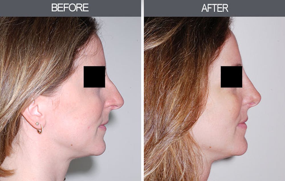 Rhinoplasty Before & After Gallery - Patient 4447208 - Image 1