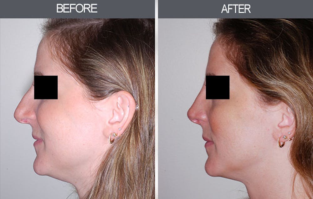 Rhinoplasty Before & After Gallery - Patient 4447208 - Image 2