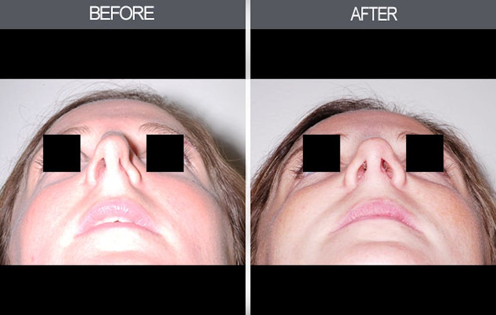 Rhinoplasty Gallery Before & After Gallery - Patient 4447208 - Image 3