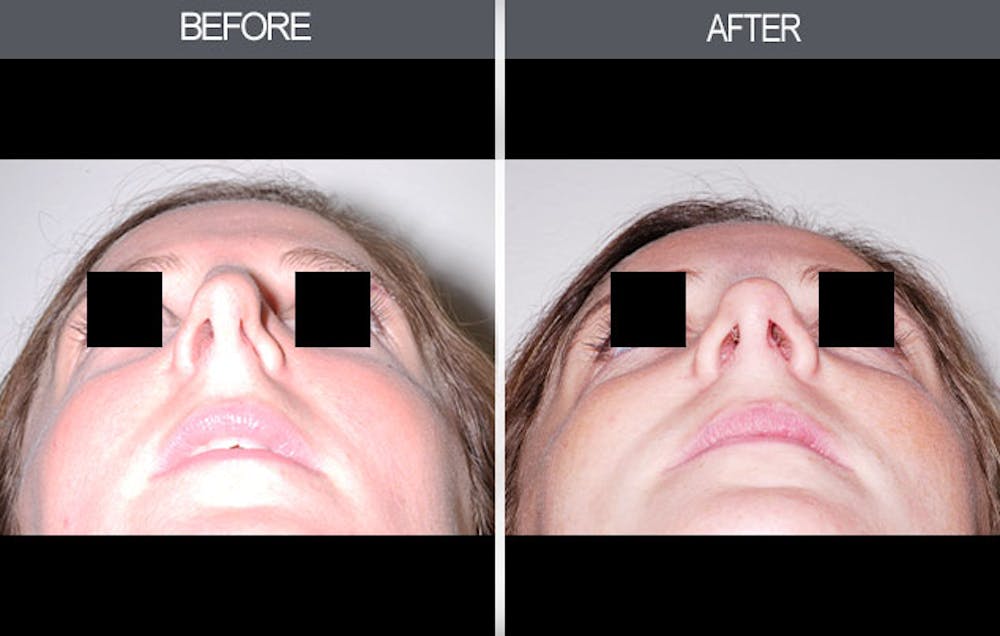 Rhinoplasty Before & After Gallery - Patient 4447208 - Image 3
