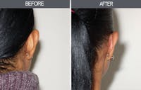 Ear Surgery Before & After Gallery - Patient 4447560 - Image 1