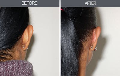 Ear Surgery Before & After Gallery - Patient 4447560 - Image 1