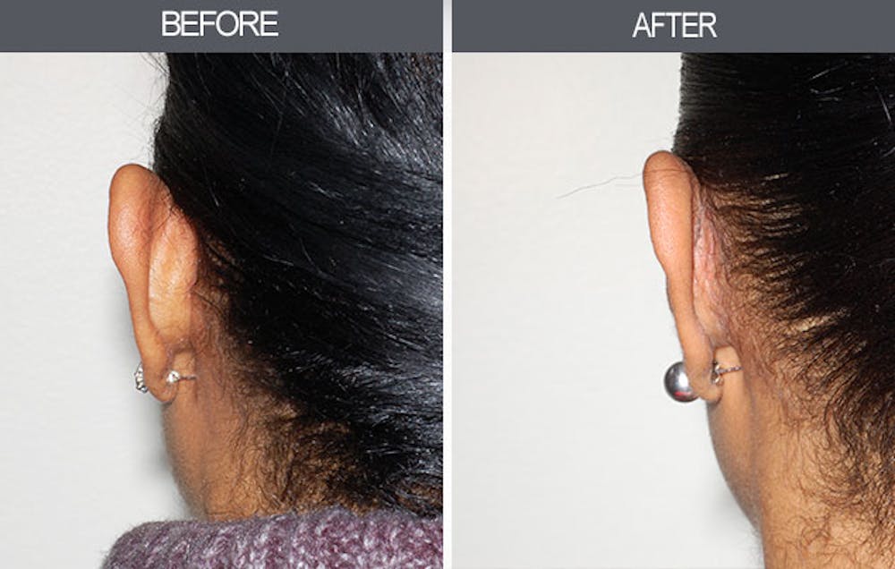 Ear Surgery Before & After Gallery - Patient 4447560 - Image 2