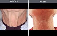 Neck Lift Gallery Before & After Gallery - Patient 4447686 - Image 1