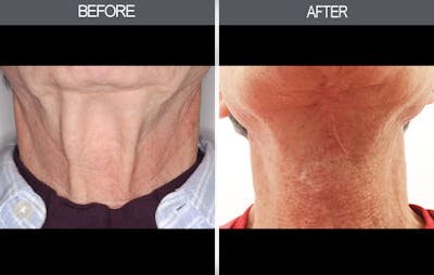 Neck Lift Gallery Before & After Gallery - Patient 4447686 - Image 1