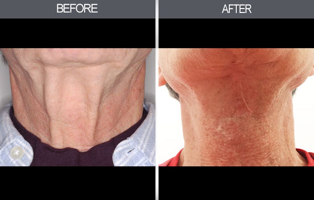 Neck Lift Before & After Gallery - Patient 4447686 - Image 1