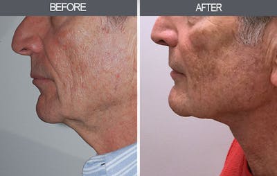 Neck Lift Before & After Gallery - Patient 4447686 - Image 2