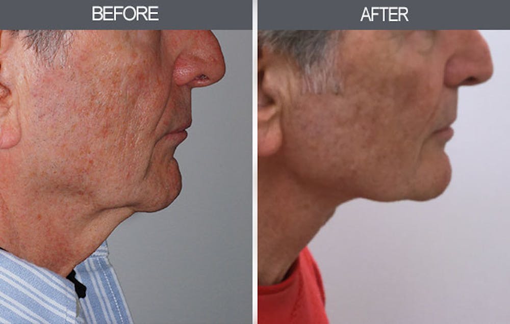Neck Lift Gallery Before & After Gallery - Patient 4447686 - Image 3