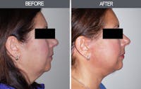 Neck Lift Before & After Gallery - Patient 4447687 - Image 1