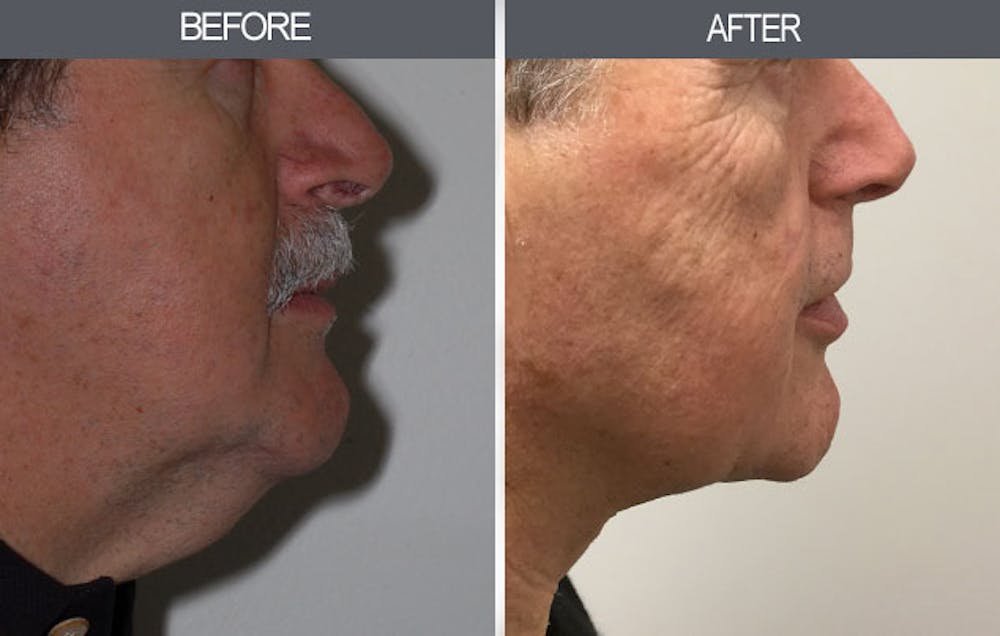 Neck Lift Before & After Gallery - Patient 4447688 - Image 2