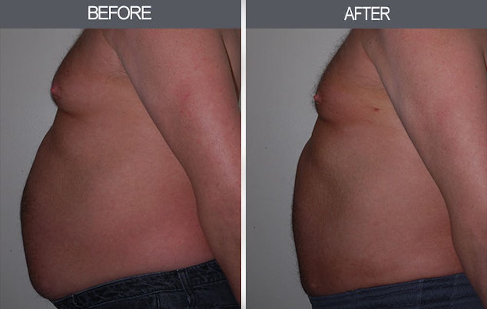 Liposuction Before & After Gallery - Patient 4448022 - Image 1