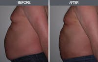 Liposuction Gallery Before & After Gallery - Patient 4448022 - Image 1