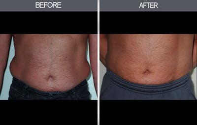 Liposuction Before & After Gallery - Patient 4448022 - Image 2