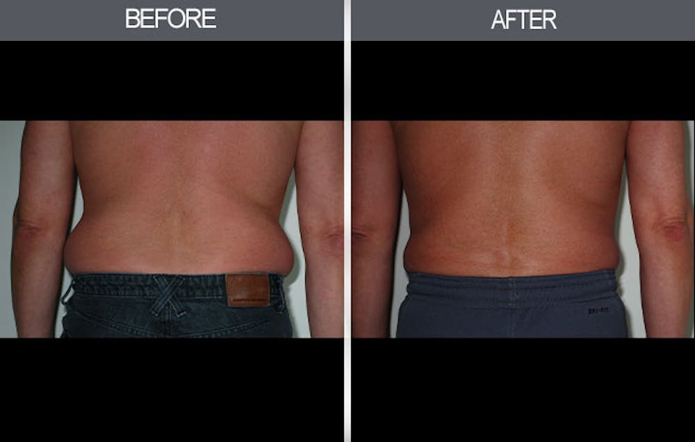 Liposuction Gallery Before & After Gallery - Patient 4448022 - Image 3