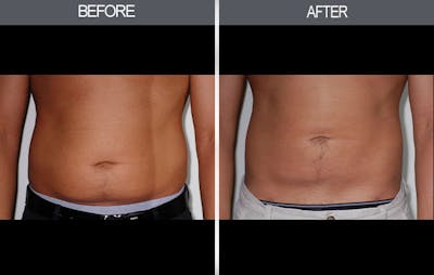 Liposuction Gallery Before & After Gallery - Patient 4448023 - Image 1