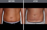 Liposuction Before & After Gallery - Patient 4448023 - Image 1