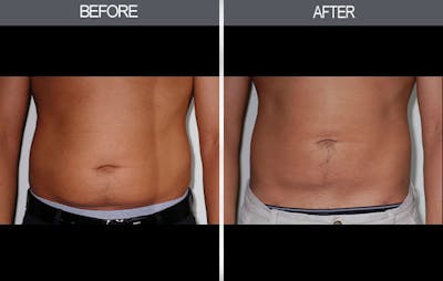 Liposuction Gallery - Patient 4448023 - Image 1