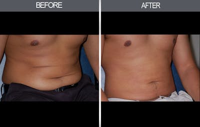 Liposuction Gallery Before & After Gallery - Patient 4448023 - Image 2