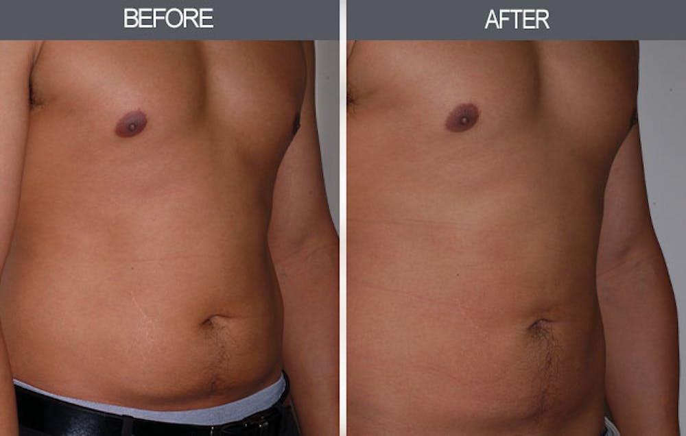 Liposuction Gallery Before & After Gallery - Patient 4448023 - Image 3