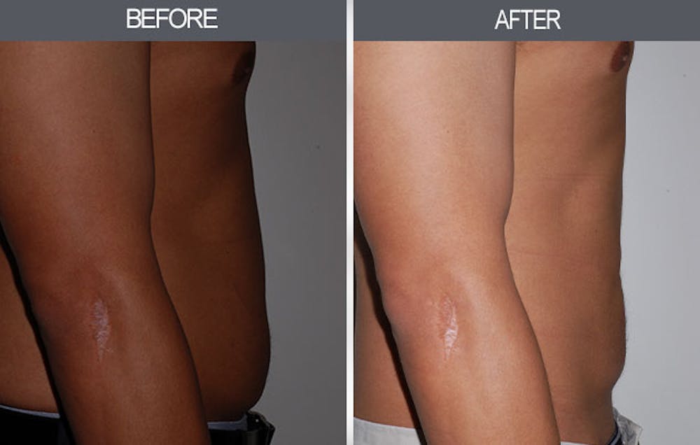 Liposuction Before & After Gallery - Patient 4448023 - Image 4