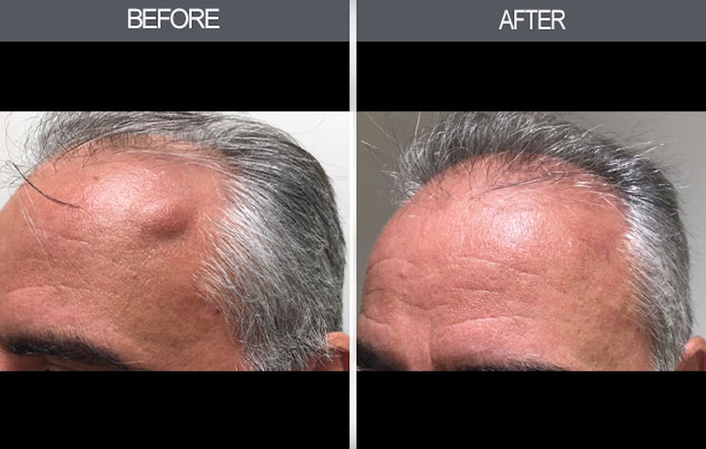 Lipoma Removal Gallery Before & After Gallery - Patient 4448356 - Image 1