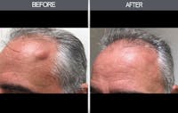 Lipoma Removal Gallery Before & After Gallery - Patient 4448356 - Image 1