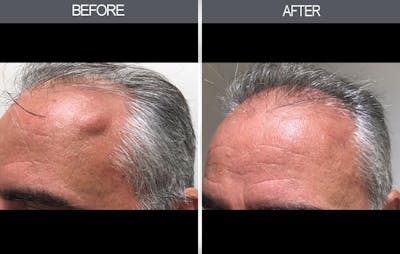 Lipoma Removal Gallery Before & After Gallery - Patient 4448356 - Image 1