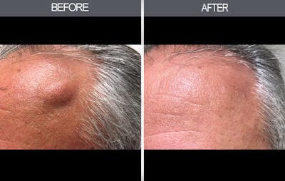 Lipoma Removal Gallery Before & After Gallery - Patient 4448356 - Image 2