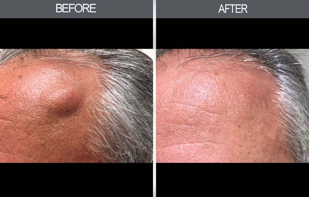 Lipoma Removal Before & After Gallery - Patient 4448356 - Image 2