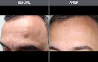 Lipoma Removal Gallery Before & After Gallery - Patient 4448357 - Image 1