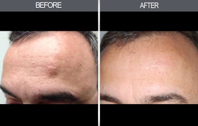 Lipoma Removal Gallery Before & After Gallery - Patient 4448357 - Image 1