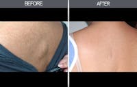 Lipoma Removal Before & After Gallery - Patient 4448358 - Image 1